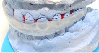 gutiera pentru scrasnit din dinti pe model