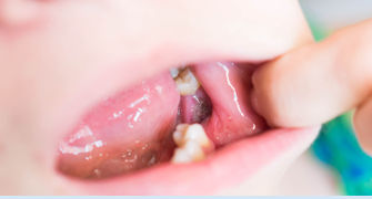 alveolita
